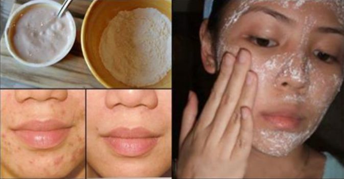 Si es posible blanquear la cutis por la agua oxigenada