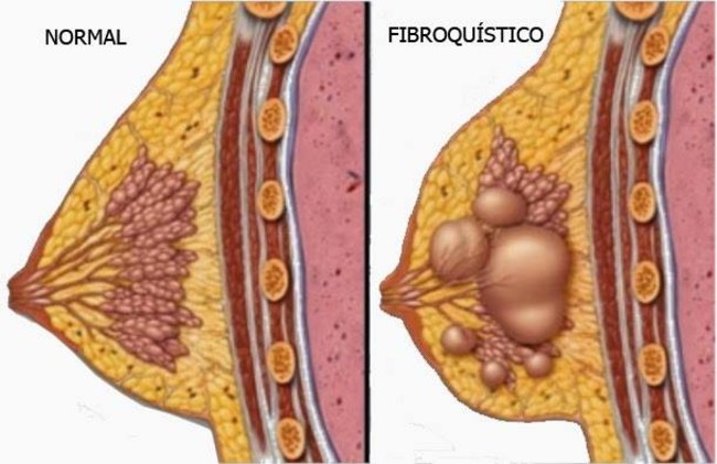 Todos los comentarios al aumento del pecho