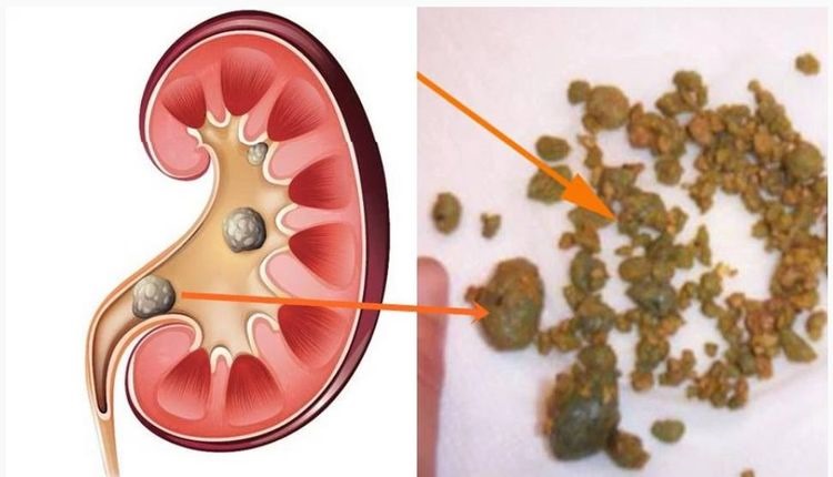 El masaje de la columna vertebral a la osteocondrosis del departamento de pecho de la columna verteb